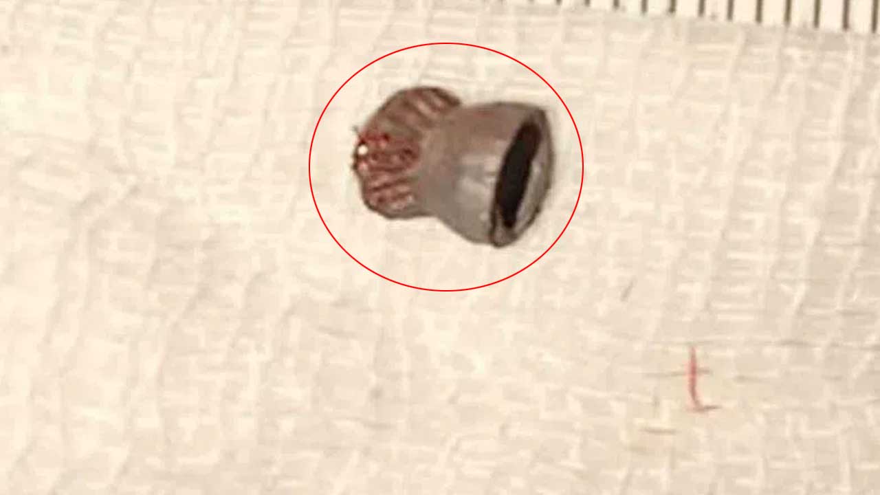 Air Gun Pellet | బాలుడి కంటిలో ఎయిర్ గన్ పెల్లెట్.. విజయవంతంగా తొలగించిన వైద్యులు