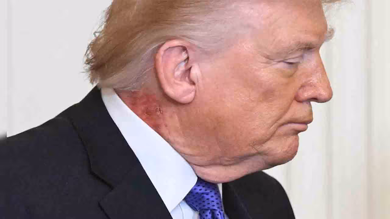 Donald Trump | ట్రంప్ మెడపై ఎర్రటి మచ్చలు.. అధ్యక్షుడి ఆరోగ్యంపై మరోసారి చర్చ మొదలు