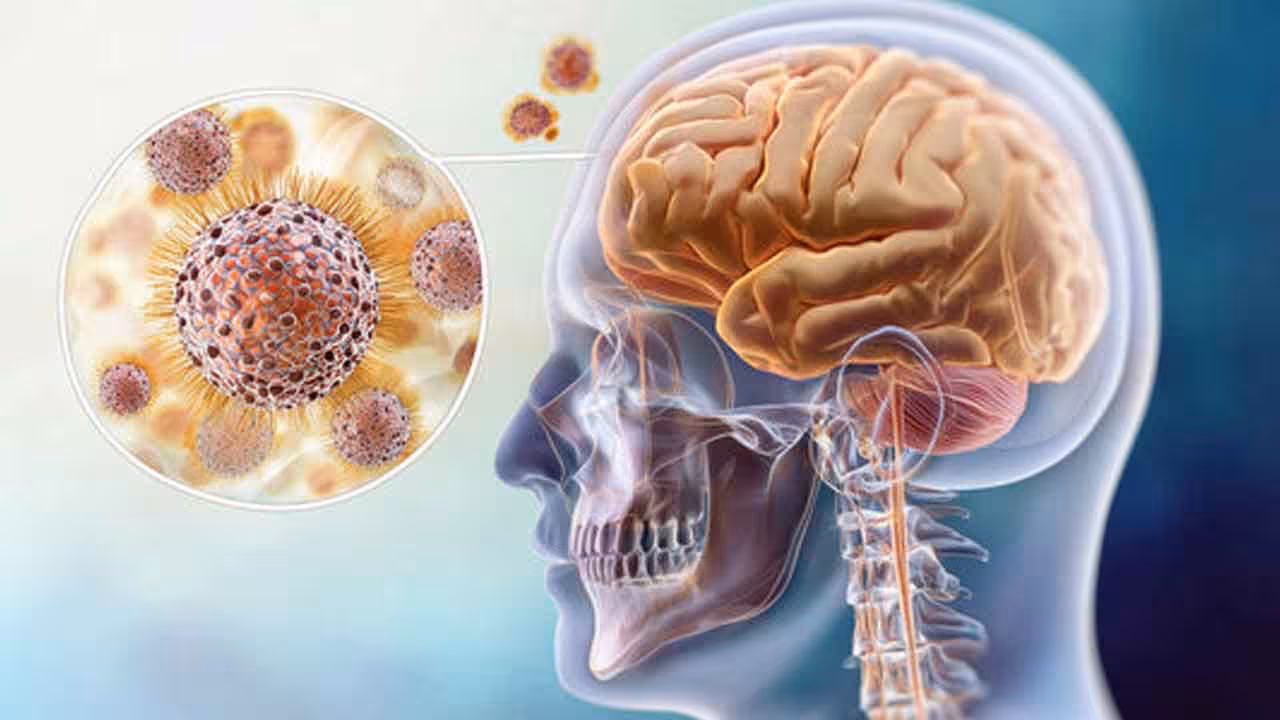Meningitis | యూకేలో ప్రబలిన మెనింజైటిస్.. అప్రమత్తంగా ఉండాలని వైద్యుల హెచ్చరిక..