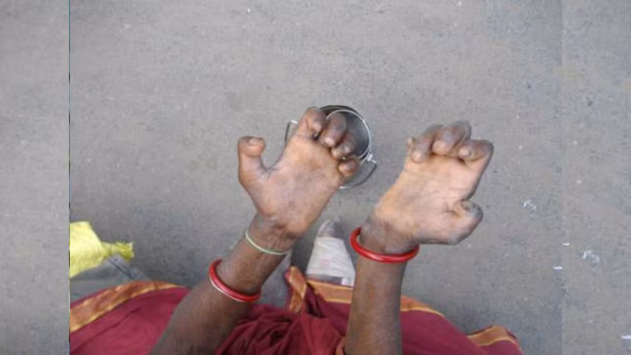Leprosy Cases | రాష్ట్రంలో మళ్లీ విజృంభిస్తున్న కుష్టు.. కొత్తగా 2500 కేసులు