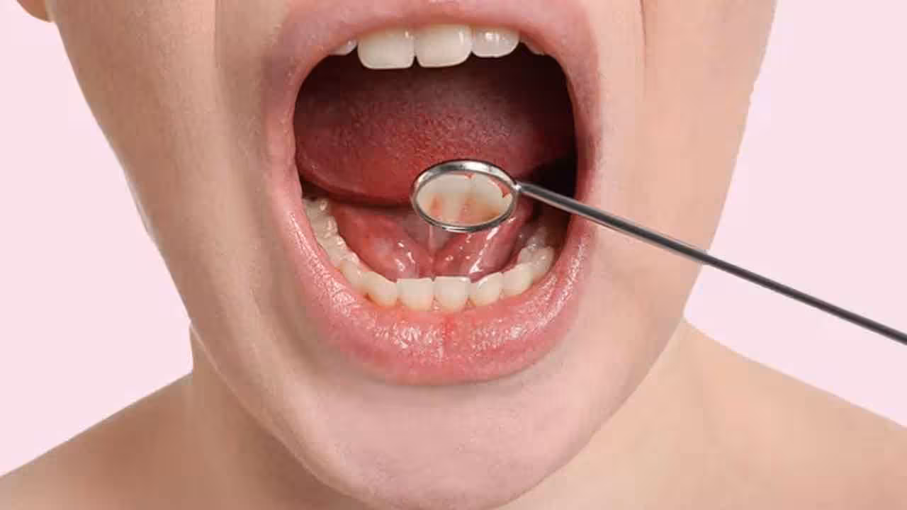 Oral Cancer | నోటి క్యాన్సర్ కేసుల్లో భారత్ టాప్.. ముందుగానే గుర్తిస్తే ప్రాణాలను కాపాడుకోవచ్చు..