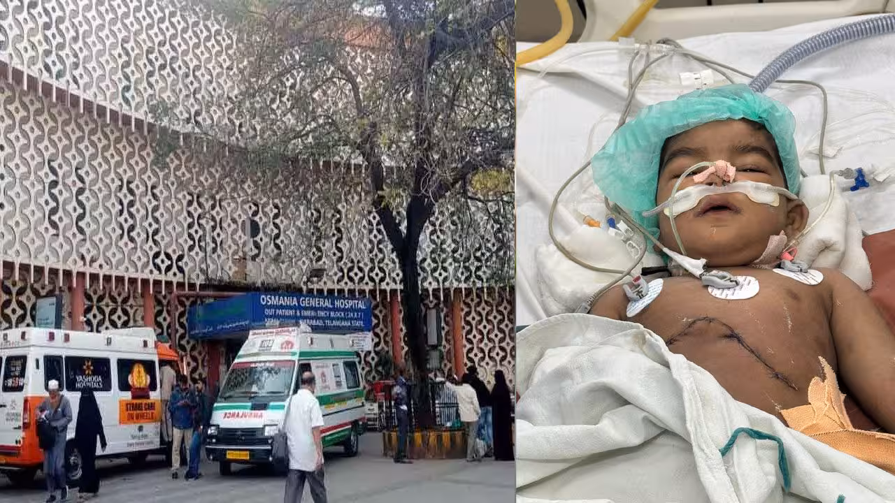 Liver Transplantation | ఉస్మానియాలో 18 నెలల చిన్నారికి విజయవంతంగా లివర్ ట్రాన్స్ప్లాంటేషన్..