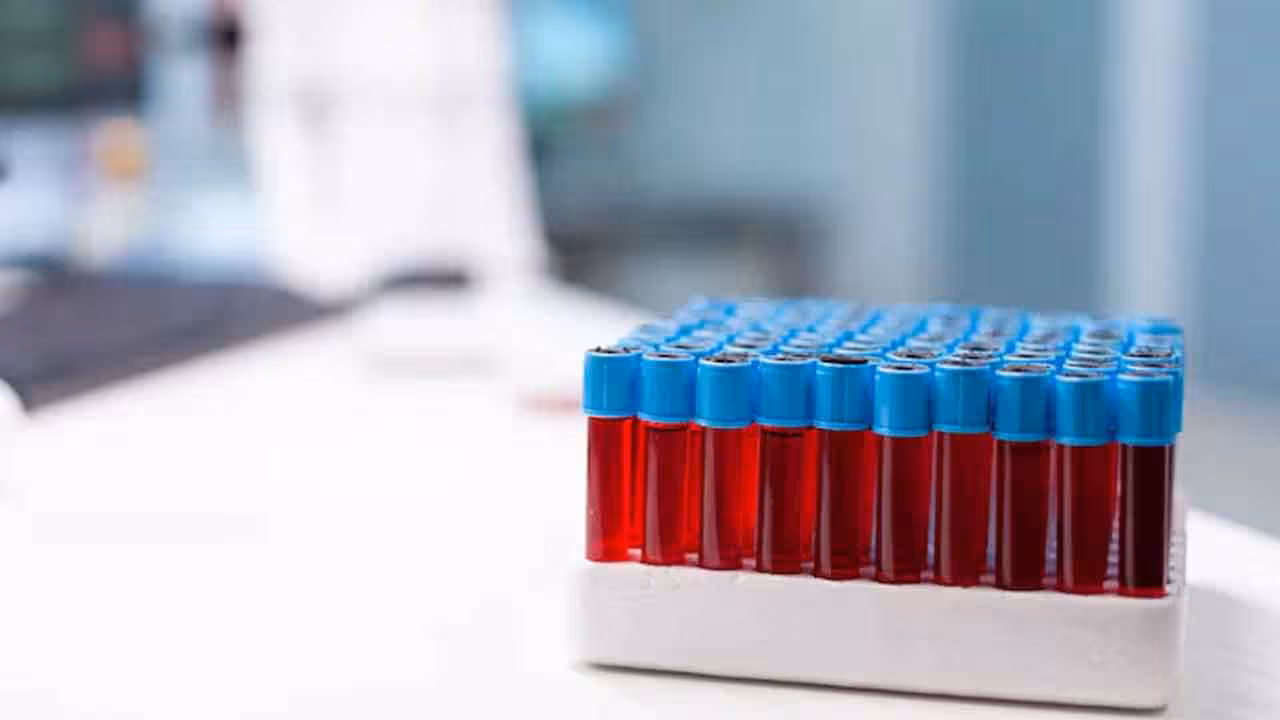 Cholesterol Tests | కొలెస్ట్రాల్ టెస్టులకు అమెరికన్ హార్ట్ అసోసియేషన్ కొత్త మార్గదర్శకాలు
