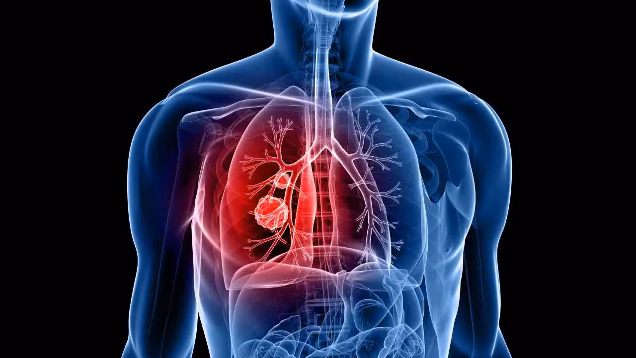 Lungs Cancer | ధూమపానం అలవాటే లేదు.. అయినా మహిళల్లో పెరుగుతున్న లంగ్ క్యాన్సర్ కేసులు..!